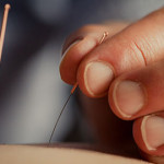 Acupuncture-CU